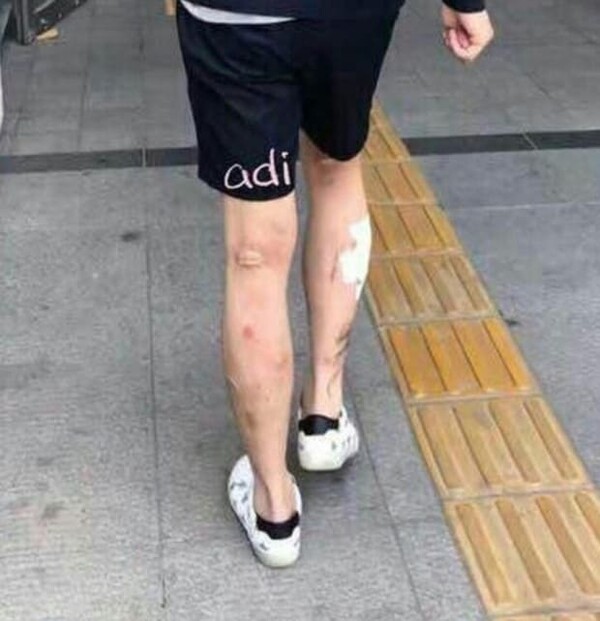 박유천의 마약 후 메스버그 현상 /사진=온라인 커뮤니티